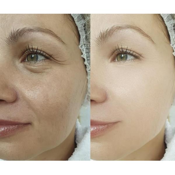 Face Pdrn Serum Skin Whitening Injection For Hyaluron Pen Microneedles