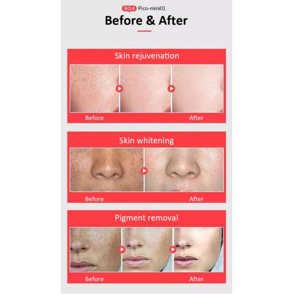 Honkon Portable Picosecond Laser Tattoo Removal Pigmentations Treatment 1