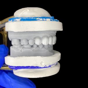 Diagnostic Wax-Up for Porcelain Veneers