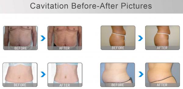 Loss weight & wrinkle removal therapy / ultra lipo cavitation+rf beauty slimming machine