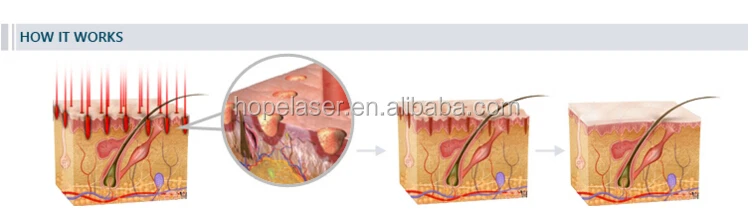 USA Coherent Metal Tube Medical RFco2 fractional laser cosmetic laser machine HP07