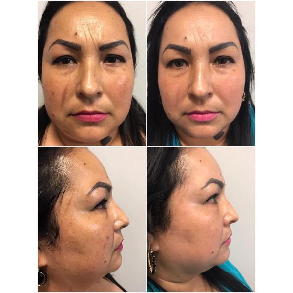 30W power 10600nm scar removal device CE approved fractional CO2 laser stretch marks