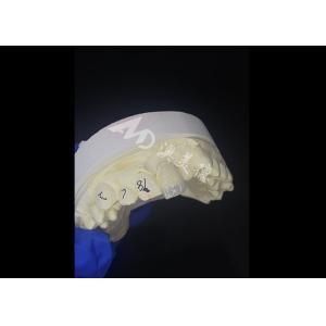 IPS e.max Veneers for incisor in shade A1 Natural Aesthetics for Flawless Smiles