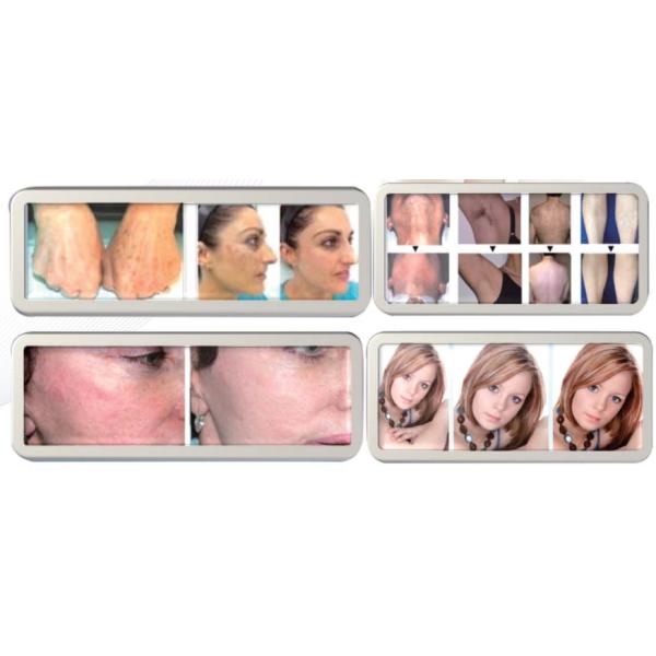 4000w Laser Hair Removal Device / SHR IPL Multifunctional Beauty Machine