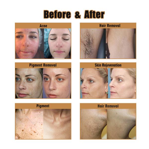 Water Electric Isolated IPL Wrinkle Removal Machine Hair Removal