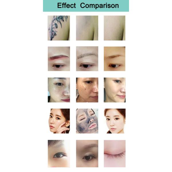 2 In 1 1064nm 808 Diode Laser Portable Q Switched Nd Yag Laser Tattoo Removal