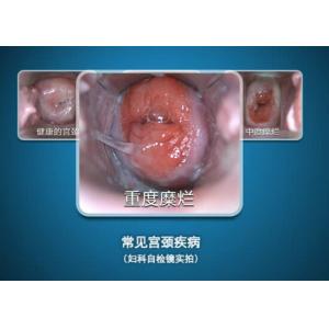 Digital Endoscope Self-Inspect Colposcope Mini Colposcopy with Range of