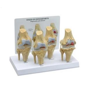 Skeleton Osteoarthritis 7.5x14x6cm Human Knee Model