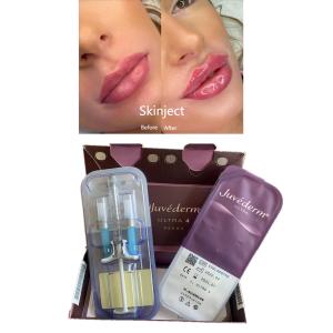 Lips Reshape Juvederm Hyaluronic Acid Dermal Filler With Lido Ultra4 2X1ml