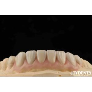 High Translucency Emax Cosmetic Dentistry Veneers High Aesthetics Ultra Thin