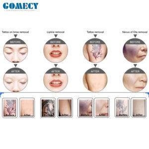 GOMECY Nd Yag Laser Shr Ipl Machine For Skin Rejuvenation