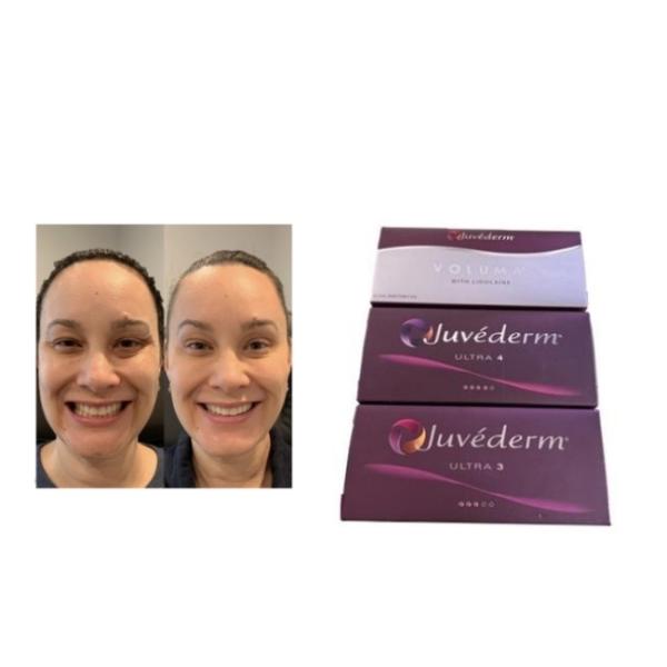 Buy Juvederm Injectable dermal filler Juvederm Ultra3 Ultra4 Voluma at wholesale prices