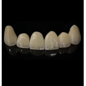 Comfortable Zirconia Crown With Good Fitting And Precision Esthetics