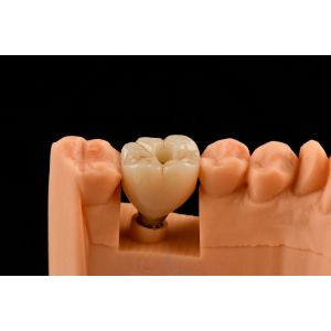 10mm Titanium Tooth Implant Sandblasted Self Tapping Dental Implants