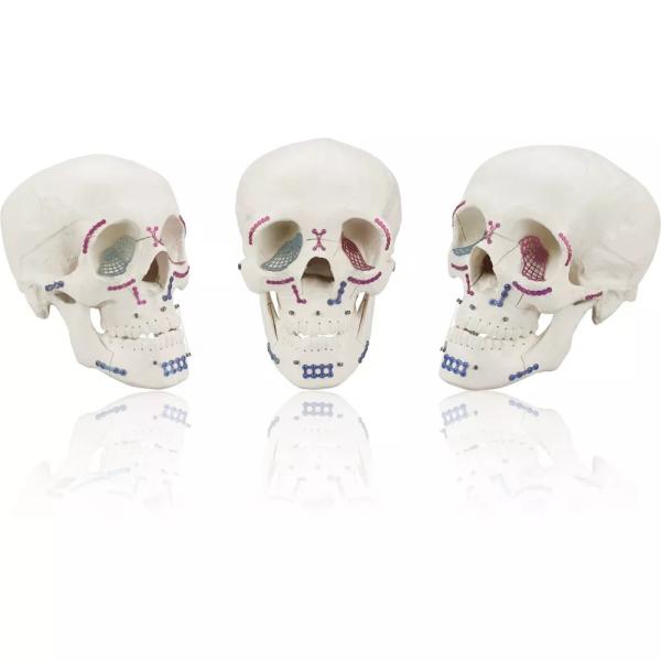 Maxillofacial Mini Locking L Plate 1.0mm System Thickness Titanium