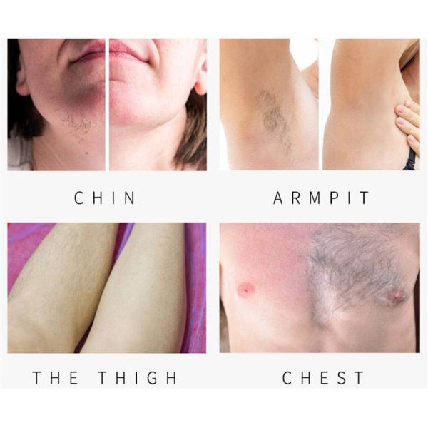 3 Wavelength Diode Laser Hair Removel Equipment 808nm 755nm 1064nm