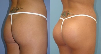 20ml Dermal Fillers For Buttocks Hyaluronic Acid Dermal Filler Hydrogel Injections