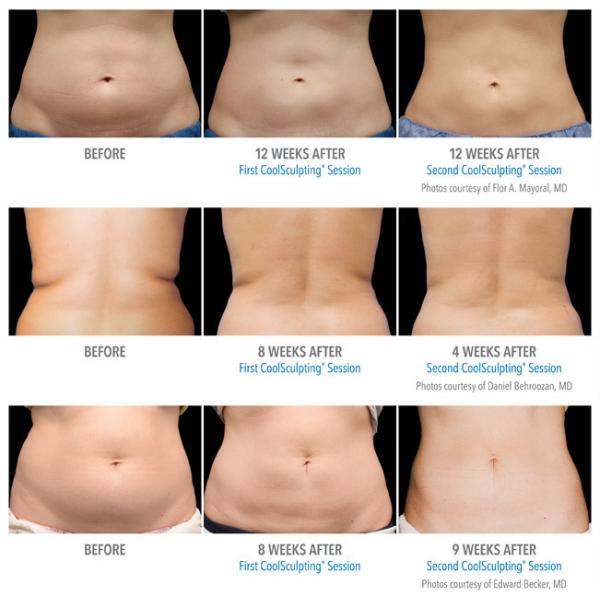 40k 5 In 1 5MHz Lipo Vacuum Slimming Machine