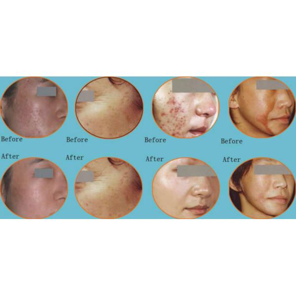 10.4 inch LCD laser hair removal device with 3 Handles IPL Pigmentation