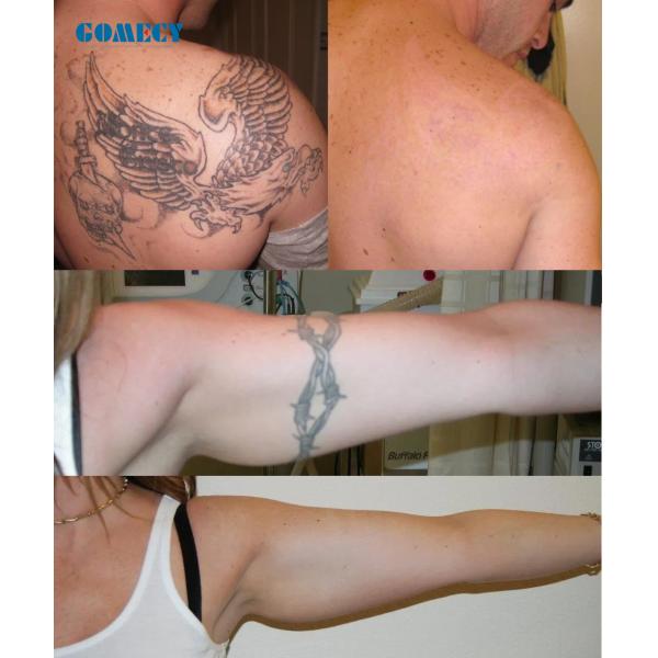 Hot Sell Portable 532 1064 1320nm Tattoo Scar Pigment Eyebrows Darker Spots Removal Machine 3 Wavelengths Skin Care 5PCS