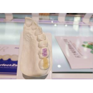 Custom High-Density Custom Dental Ceramics FDA All-Ceramic Crown
