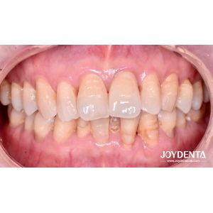 Zirconia dentures that imitate natural teeth