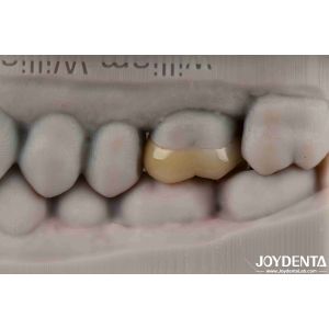 Easy To Clean And Durable Emax Inlay Onlay Resistance To Staining For Optimal