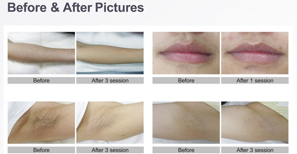 IPL SHR Skin Tightening Rejuvenation Hair Removal Equipment With Different Wavelength