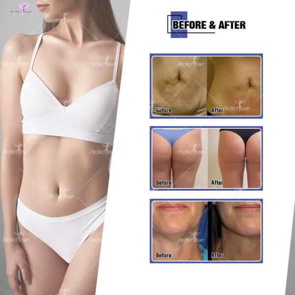 Cavitation RF Slimming Machine Vacuum Laser Fat Burning Machine