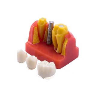 Class III Instrument Classification Dental Study Model for Dental Practice and