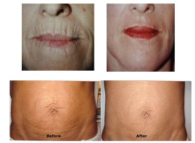 200W 110V Slimming Professional RF Beauty Equipment for Face / Neck Wrinkle Eliminating