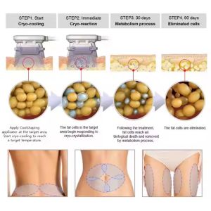 Cryolipolysis Vertical 4 Handles Multifunctional Body Shape 360 Cool Cryolipolys