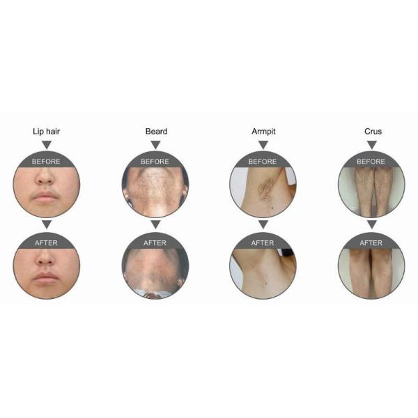 MED - 808 peak power 2000w net weight 43kgs portable diode laser hair removal painfree machine