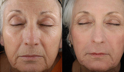 Medical Fractional CO2 Laser For Under Eye Wrinkles / Skin Rejuvenation