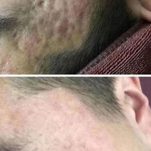 Secret Portable Radiofrequency Facial Skin Tightening RF Fractional Microneedle