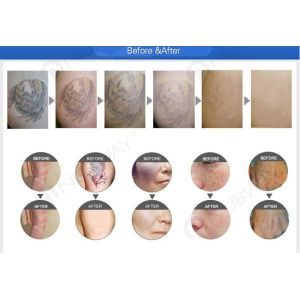 2017 high energy factory price q yag laser picosecond