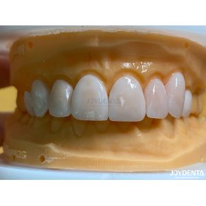 High Permeability Natural Looking Veneers Porcelain Veneers Emax Customized