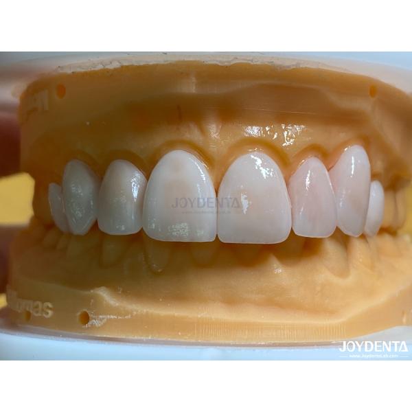 Buy High Permeability Natural Looking Veneers Porcelain Veneers Emax Customized at wholesale prices