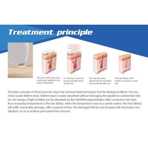 best selling advanced technology permanent fast treatment 1800W powerful diode