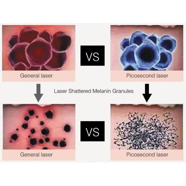 picosecond laser all skin types tattoo / skin whitening / freckle removal machine