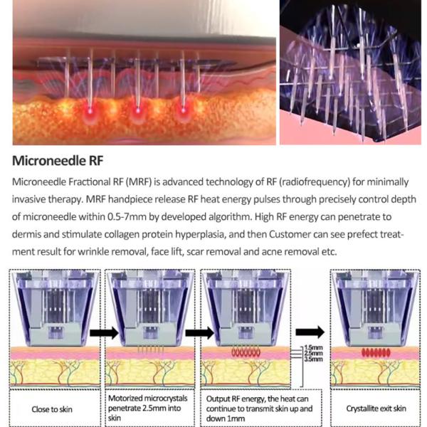 2 PCS Nano-L RF Heads Microneedle RF Device for Effective Face Lifting and Wrinkle Reduction Beauty Treatment