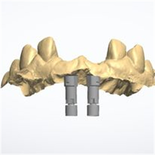 Buy 3D model Zirconia crown at wholesale prices