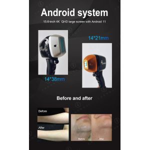 Smart Android 2 in 1 Diode Laser Hair Removal Machine with 755nm 808nm