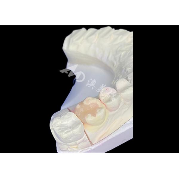 Buy IPS e.max Ceramic Inlays and Onlays for Molar Restoration with Durable Aesthetic and Natural Looking Results at wholesale prices