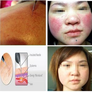 30MHz Spider veins removal machine for spider vein laser