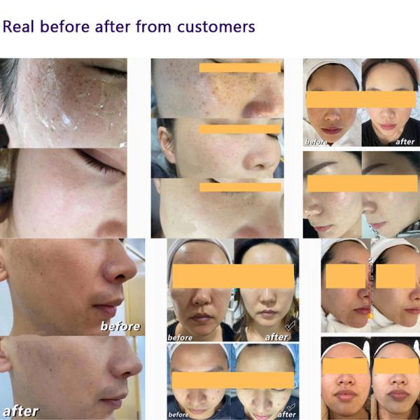 Skin Rejuvenation IPL Laser Hair Removal Machine 1300nm 550nm 500nm Wavelength