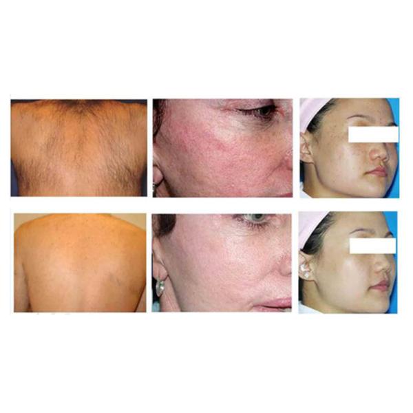 Double Handpiece IPL SHR Hair Removal Machine Vascular Pigment Therapy Elight