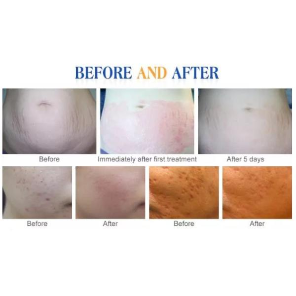 Newest 5 in 1 Derma Vib 540 Needles Derma Roller Dermaroller