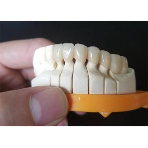 Custom Size PFM Ceramic Crowns For Posterior And Anterior Teeth