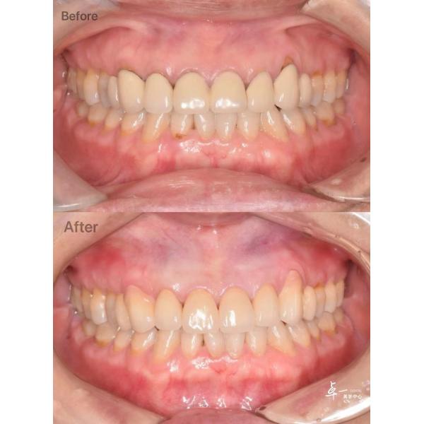 High Fracture Resistance Dental Zirconia For Safe Oral Tissue And CAD / CAM